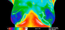 Thermography as an adjunct to Mammography