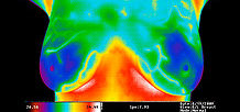 Please recognise Thermography as an adjunct to Mammography!